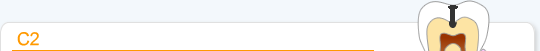 虫歯の進行　C2
