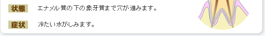 エナメル質の下の象牙質まで穴が進みます。冷たい水がしみます。