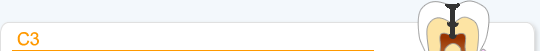 虫歯の進行　C3