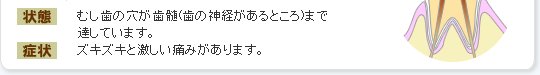 むし歯の穴が歯髄(歯の神経があるところ)まで達しています。ズキズキと激しい痛みがあります。