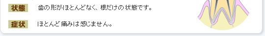 歯の形がほとんどなく、根だけの状態です。ほとんど痛みは感じません。