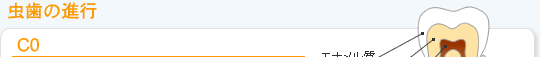 虫歯の進行　C0